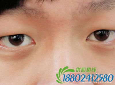 不能分辨红和绿这两种颜色，为一种先天性的色觉障碍病