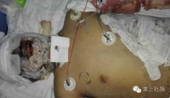 “南阳油罐车爆炸”续：社旗一大学生伤情严重
